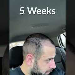 Hair Transplant Process - Week by Week - 3 Months