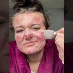 Best Pimple Patch Removals