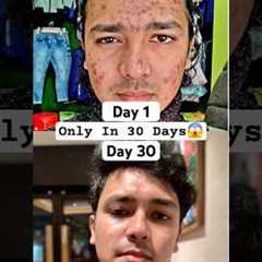 My Acne Journey | 1 Month Pimple Cure | I Cleared My Acne Only In 30 Days #acne #pimple #skincare