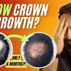 Crown Hair Not Growing? Here’s Why (and How to Speed It Up)