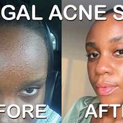 fungal acne safe skincare routine (doctor approved)