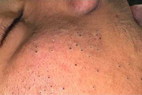 ASMR Facial Care Routine for Clear Skin - Deep Cleansing, Blackhead Removal &amp; Pimple Treatment