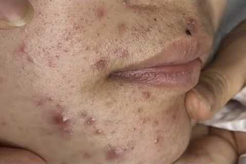 pimple popper blackhead remove,#001 