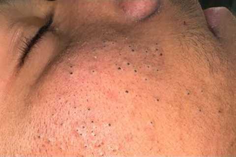 Deep Blackhead Removal &amp; Pimple Treatment | Ultimate Facial Care Routine
