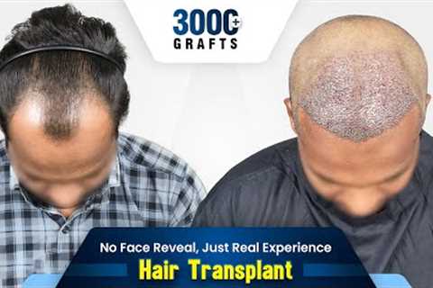 Grade 3 Hair Transplant in India | Hair Transplant Results &amp; Cost in India #hairtransformation