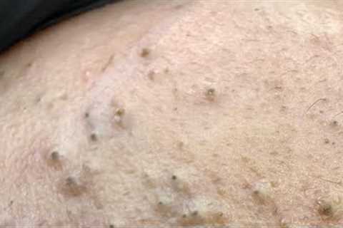 ASMR Facial Care Routine for Acne-Free Skin - Deep Cleansing & Natural Remedies
