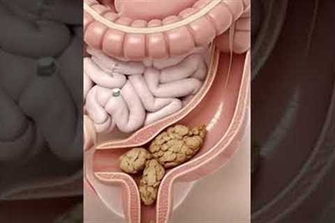 3D Animation of Constipation Explained | Gut Health