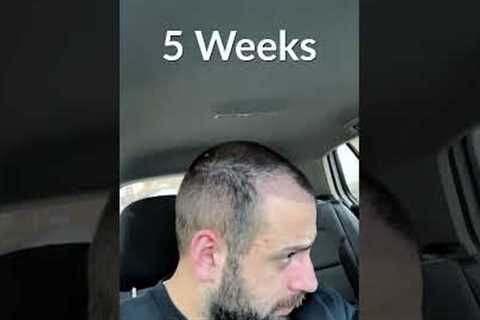 Hair Transplant Process - Week by Week - 3 Months