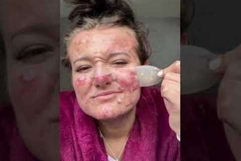 Best Pimple Patch Removals
