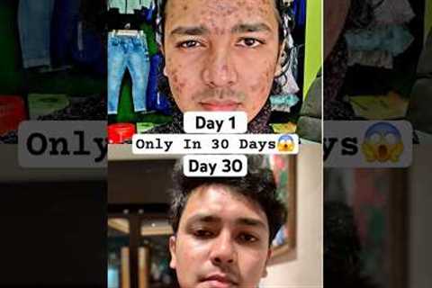 My Acne Journey | 1 Month Pimple Cure | I Cleared My Acne Only In 30 Days #acne #pimple #skincare