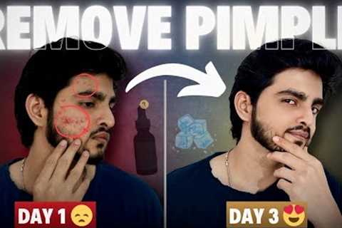 Face Pimples Removal Naturally | 3 DIN ME PIMPLE GAYAB 😱| Acne Treatment at Home | Pimple Treatment