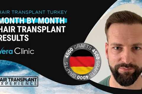 Month by Month #hairtransplant Time Lapse Before After Results #hairtransplantturkey #4500grafts