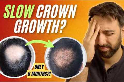 Crown Hair Not Growing? Here’s Why (and How to Speed It Up)