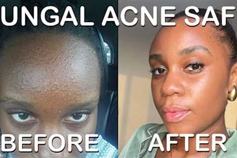 fungal acne safe skincare routine (doctor approved)