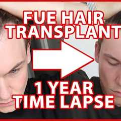 FUE Hair Transplant Timeline 1 YEAR | day 1-365 | 12 Months Progress Before and After