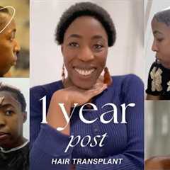 1 YEAR AFTER HAIR TRANSPLANT RESULT + TIME LAPSE + HAIR LOSS