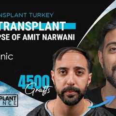 1 Year of Hair Transplant Results Time Lapse in Turkey #hairtransplant #hairtransplantturkey