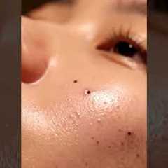 “Deep Pore Vacuum Cleaning ASMR | Intense Blackhead Suction Sounds”