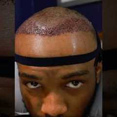 1 Year Hair Transplant Update👨🏾‍🦲‼️