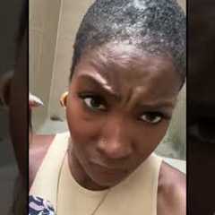 Hair transplant 6 month update short