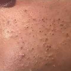 asmr deep cleansing facial blackhead extraction & relaxing skin care