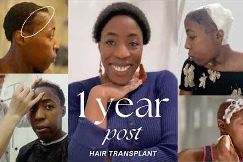 1 YEAR AFTER HAIR TRANSPLANT RESULT + TIME LAPSE + HAIR LOSS