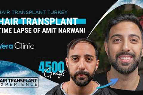 1 Year of Hair Transplant Results Time Lapse in Turkey #hairtransplant #hairtransplantturkey