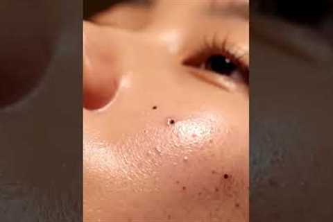 “Deep Pore Vacuum Cleaning ASMR | Intense Blackhead Suction Sounds”
