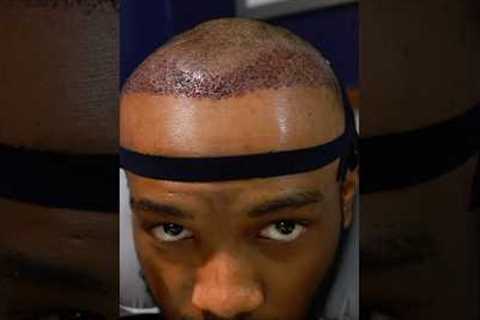 1 Year Hair Transplant Update👨🏾‍🦲‼️