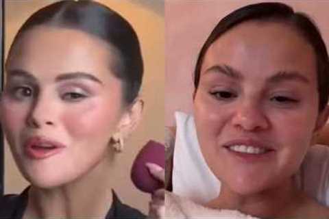 Selena Gomez ADDICTION To Fillers Is DESTROYING Her Face
