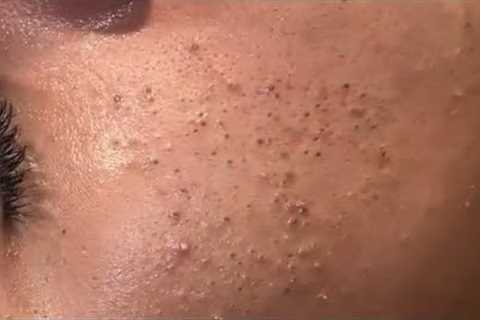 asmr deep cleansing facial blackhead extraction & relaxing skin care