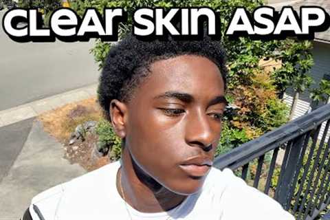 how to get clear skin for guys asap