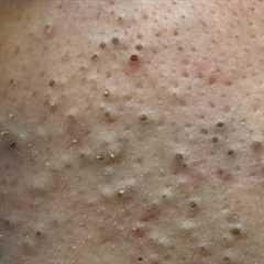 [ASMR] Ultimate Pimple Treatment: Korean Skincare Routine for Acne-Prone Skin & Blackheads