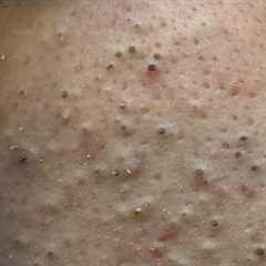 [ASMR] Morning & Nighttime Facial Routines for Acne-Prone Skin & Blackheads