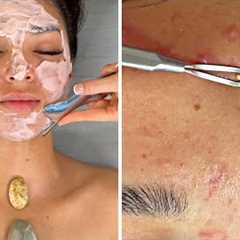 ACNE NO Talking SPA-ASMR Facial {Pimple Popping!!!}