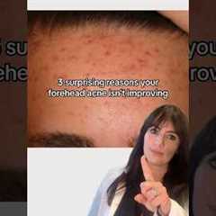 4 reasons why your forehead acne isn’t improving👆🏽 #acne #acnehelp #acneproneskin #acnetreatment