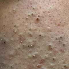 [ASMR] Korean Skincare Routine for Acne and Blackheads, Satisfying Facial Care