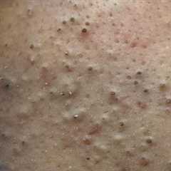 [ASMR] Daily Skincare Routine: Deep Cleansing Techniques for Blackheads and Acne