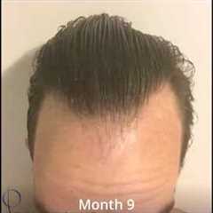 Daily Time Lapse of Hair Growth after Surgery: Tracking a Year of Growth (Carlos K. Wesley, MD)