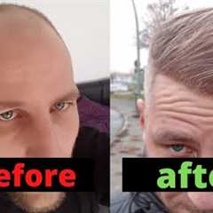 From Day 0 to Month 12 - Hair Transplant Turkey Comparison