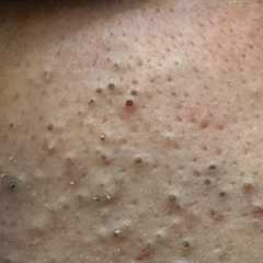 [ASMR] Facial Care for Clear Skin: Korean Skincare Routine for Blackhead Removal & Pimple..