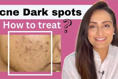 Acne Dark Spots | हिंदी | How to treat | serum cream recommendations | Dermatologist | Dr. Aanchal