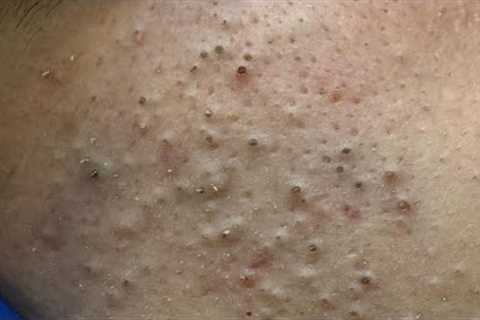 [ASMR] Ultimate Pimple Treatment: Korean Skincare Routine for Acne-Prone Skin &amp; Blackheads