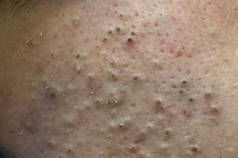 [ASMR] Morning & Nighttime Facial Routines for Acne-Prone Skin & Blackheads