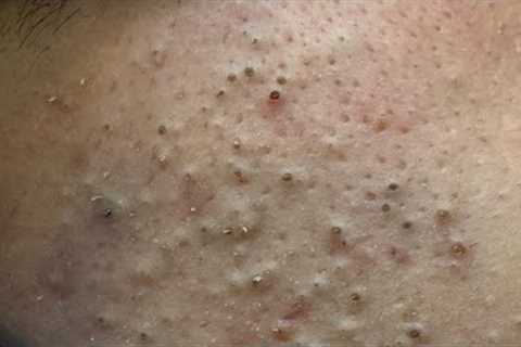 [ASMR] Korean Skincare Routine for Acne and Blackheads, Satisfying Facial Care