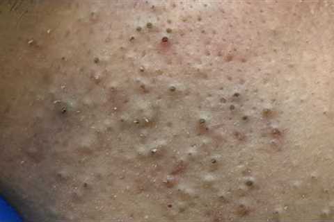 [ASMR] Daily Skincare Routine: Deep Cleansing Techniques for Blackheads and Acne