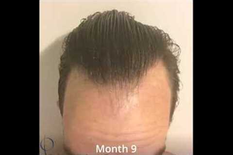 Daily Time Lapse of Hair Growth after Surgery: Tracking a Year of Growth (Carlos K. Wesley, MD)