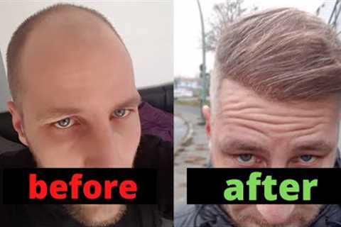 From Day 0 to Month 12 - Hair Transplant Turkey Comparison
