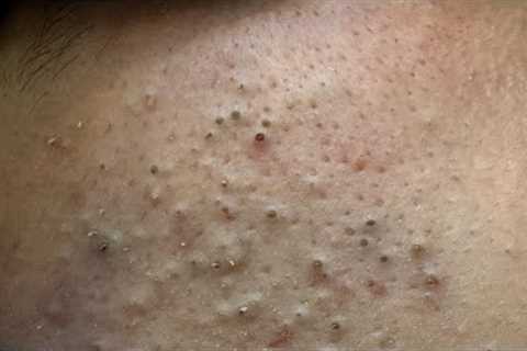[ASMR] Facial Care for Clear Skin: Korean Skincare Routine for Blackhead Removal &amp; Pimple..
