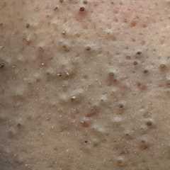 [ASMR] Facial Care Routine for Pimple and Blackheads Removal, Satisfying Skincare